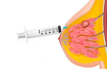 biopsia de mama baaf